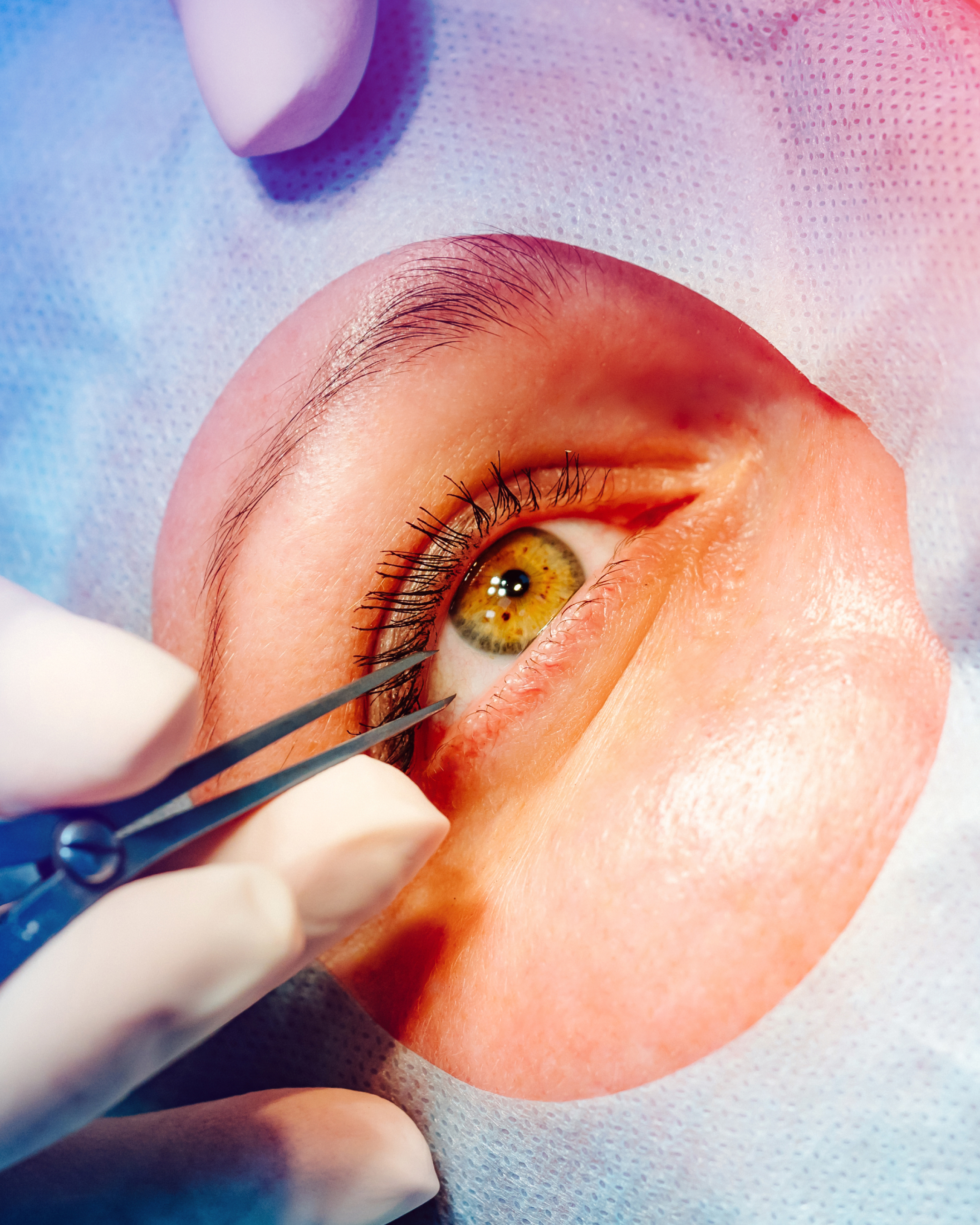 Lens replacement surgery at The Eye Doctor, Huddersfield